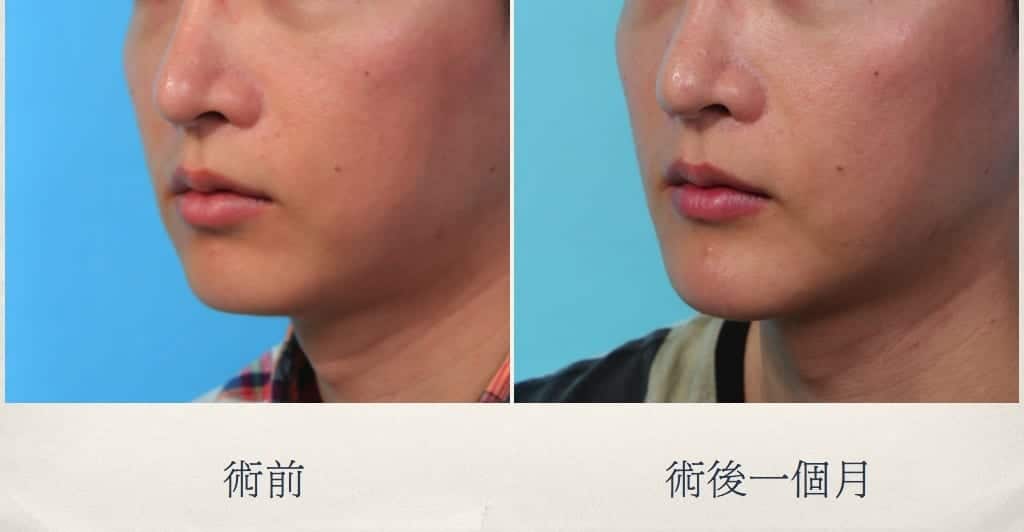 下巴整形、墊下巴心得、整形外科醫師推薦、台北微整型推薦、台北整型診所推薦.jpg 的副本
