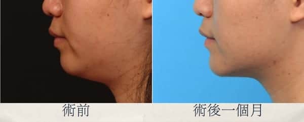 下巴整形、尖下巴整形、下巴整形推薦、墊下巴費用、台北墊下巴推薦.jpg 的副本