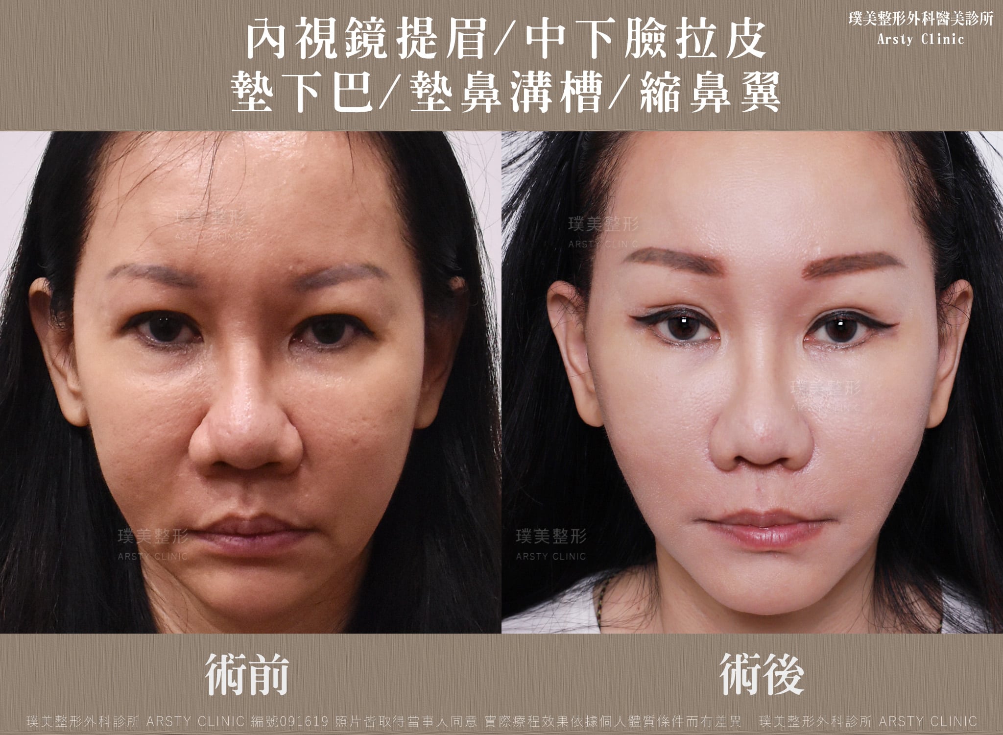 中下臉拉皮-內視鏡提眉-091619-1