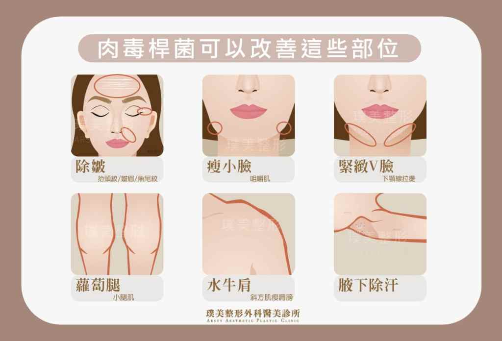 肉毒止汗療程-02