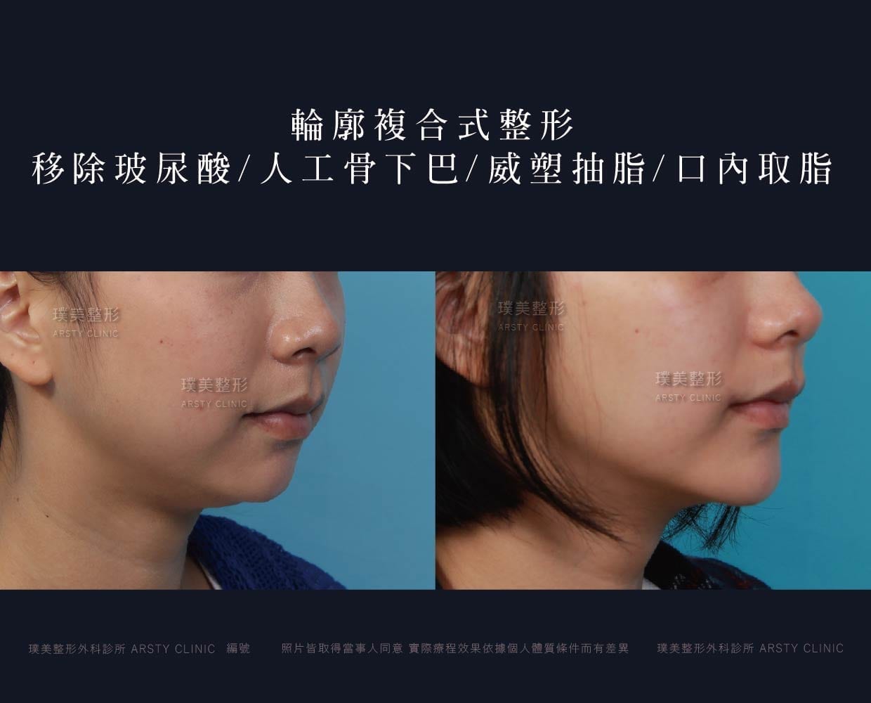 下巴手術.墊下巴手術.人工骨下巴