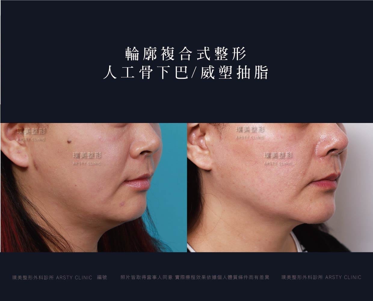 下巴手術.墊下巴手術.人工骨下巴
