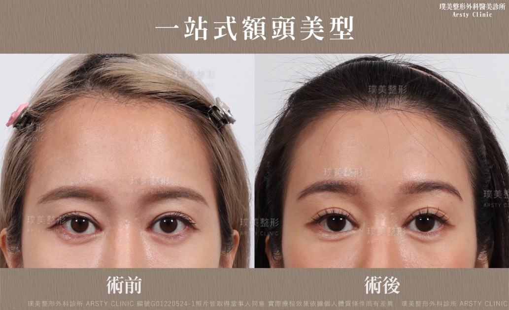 Endoscopic Forehead Lift - hairline reduction