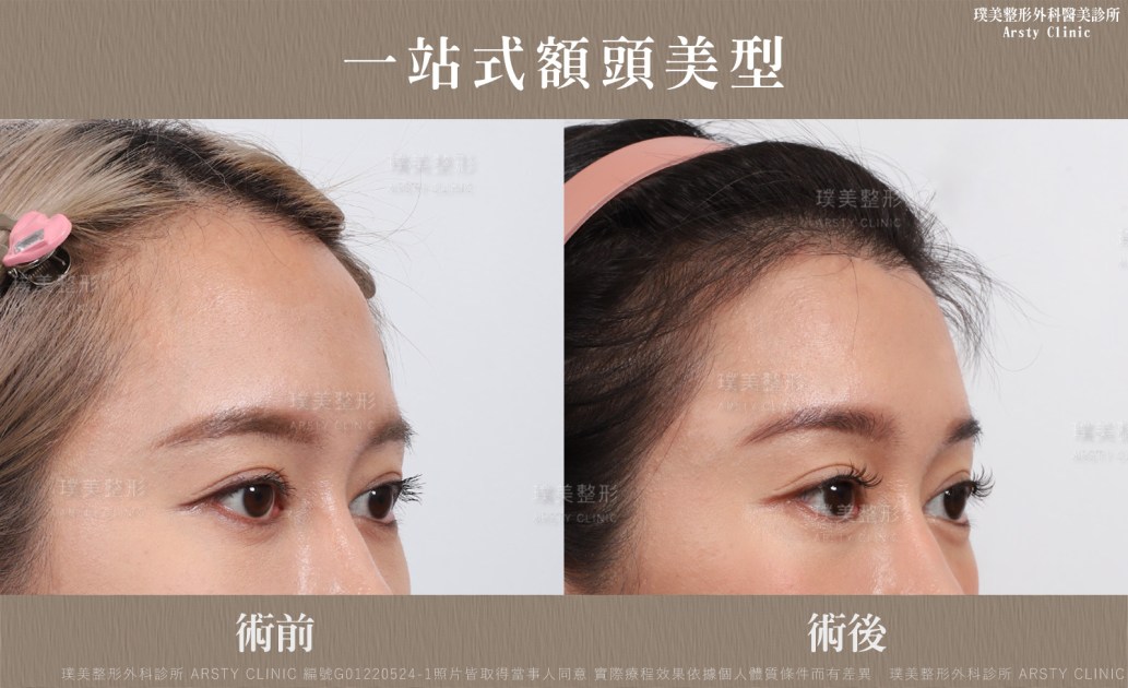 Endoscopic Forehead Lift - hairline reduction