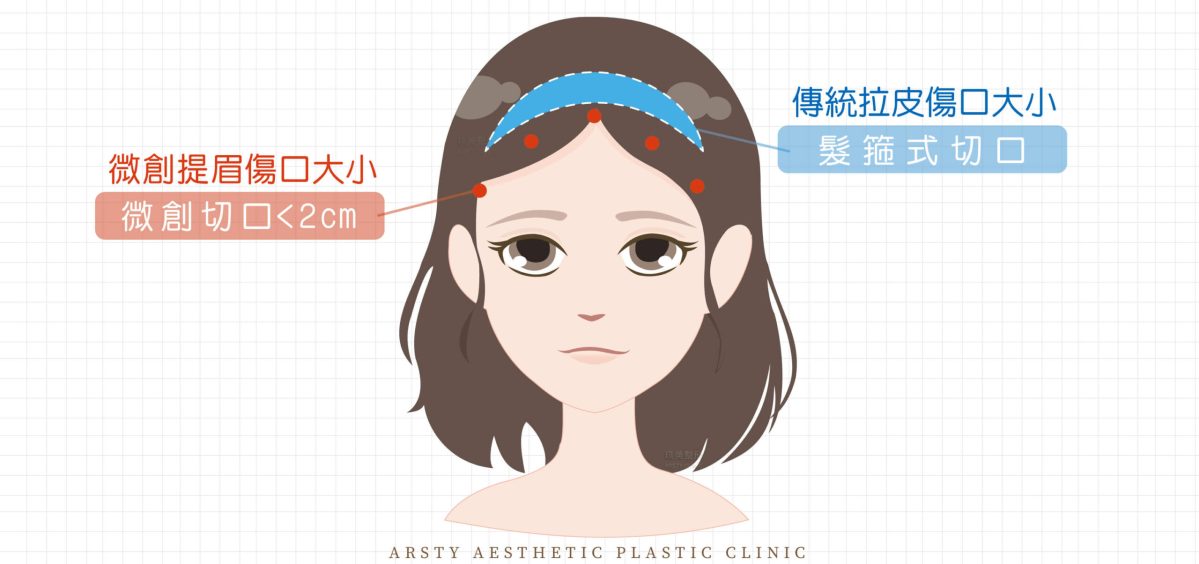 Differences between Endoscopic Forehead Lift and traditional facelift incision