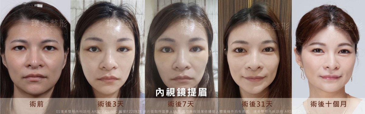 %E5%85%A7%E8%A6%96%E9%8F%A1%E6%8F%90%E7%9C%89%E6%81%A2%E5%BE%A9%E6%9C%9F%E8%AE%8A%E5%8C%96 F220928