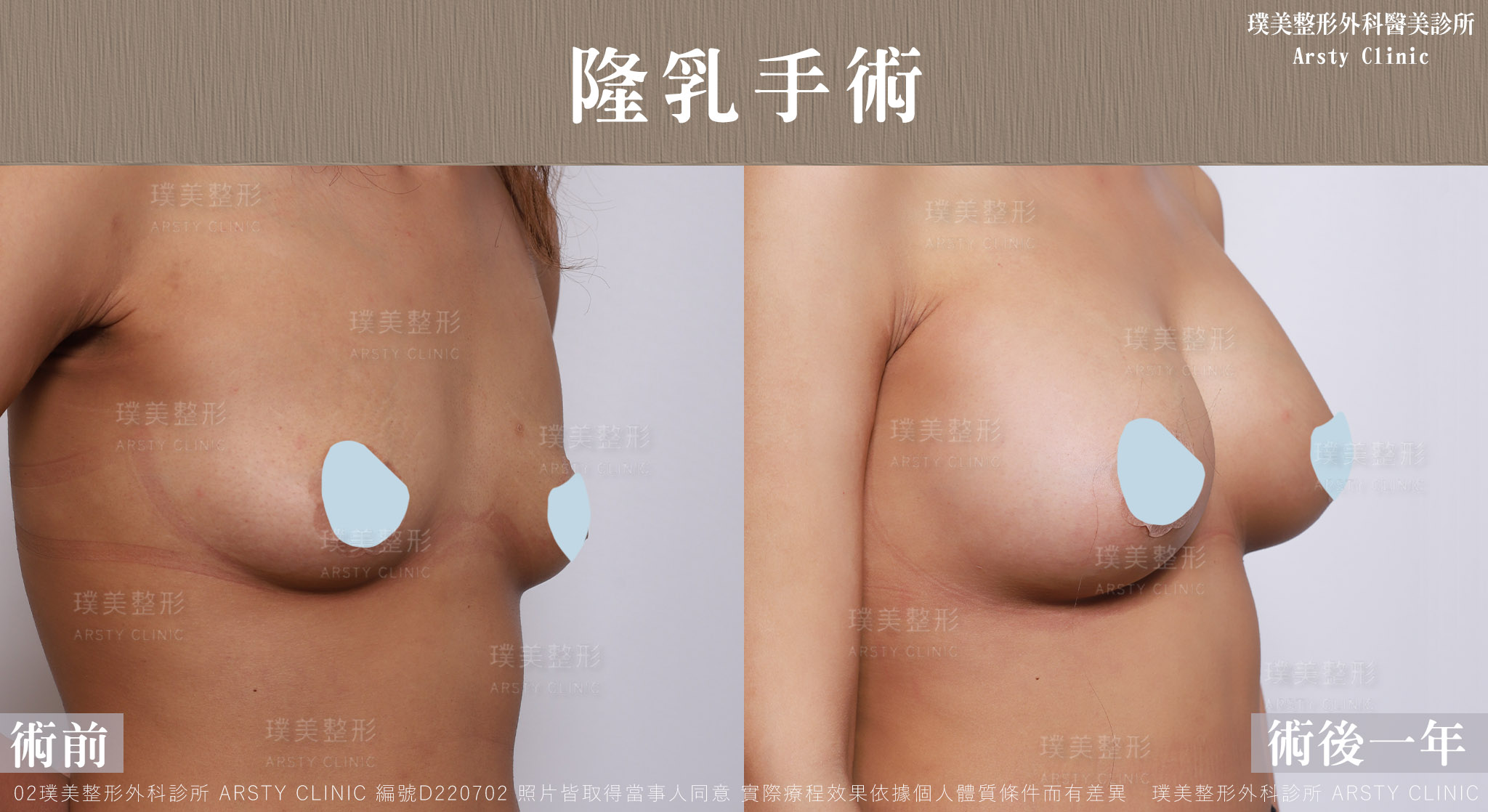 果凍矽膠隆乳_D220702BA-1Y02