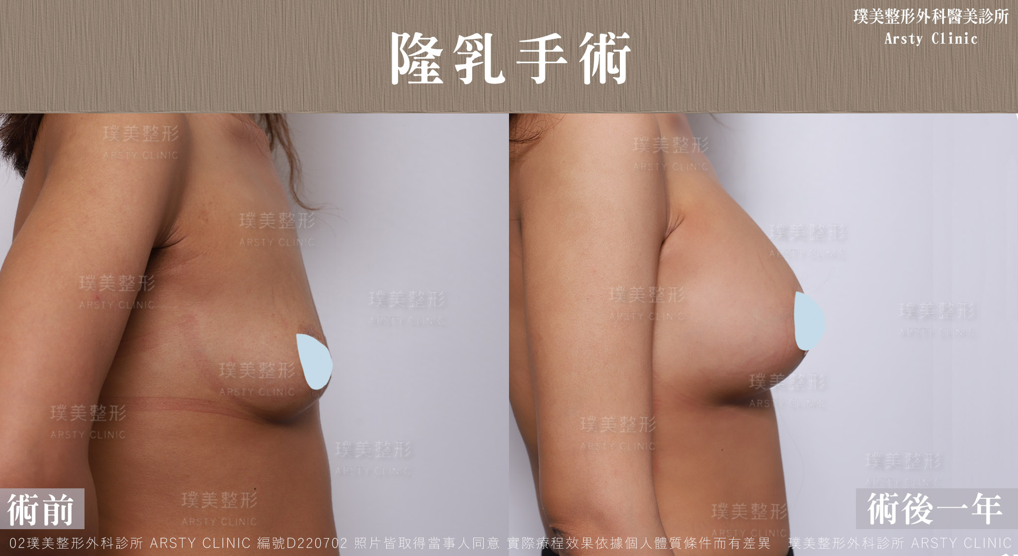 果凍矽膠隆乳_D220702BA-1Y03