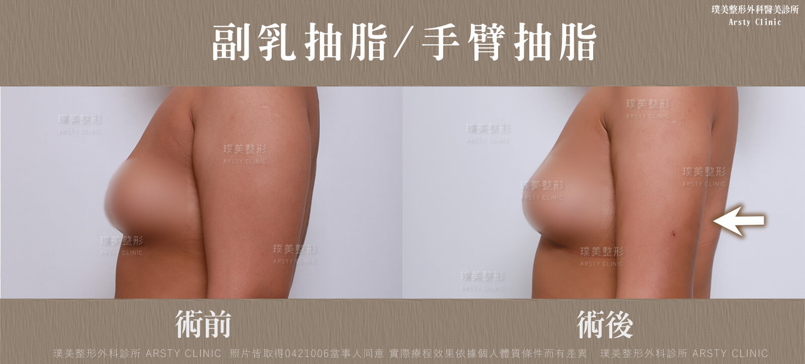 Vaser2.2二代威塑抽脂-曲線雕塑、體態美學再進化 41 21手臂抽脂 副乳抽脂 抽脂頁面BA 局