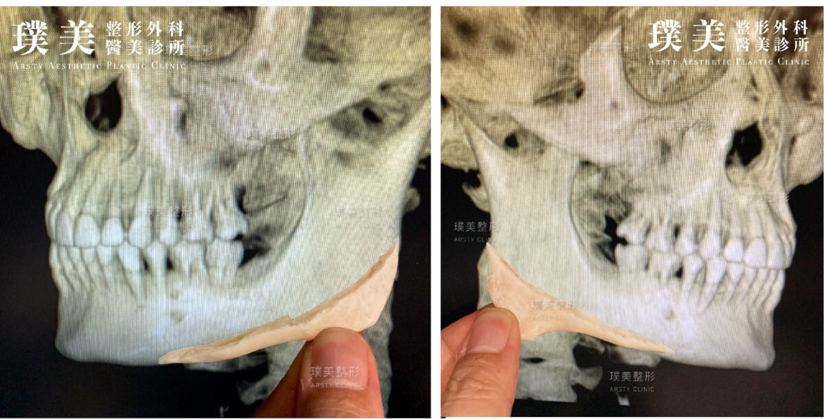 正顎手術3D斷層掃描影像系統