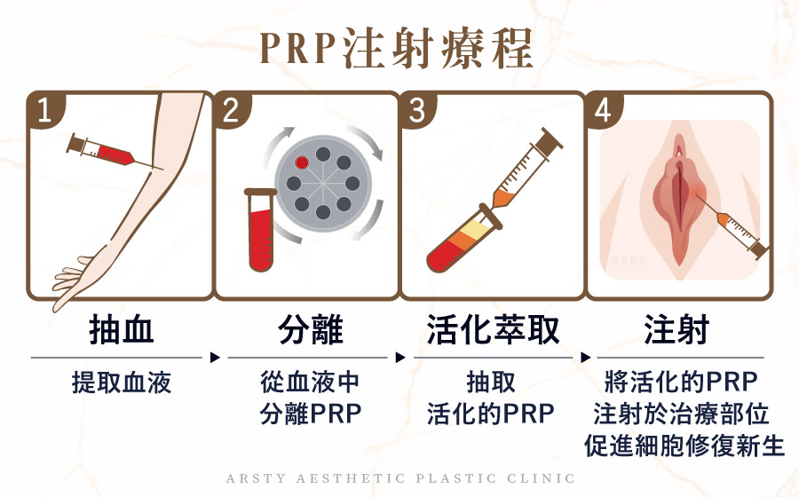 PRP注射療程