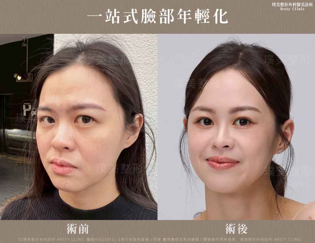 一站式臉部年輕化_H01220411-1_生活照01
