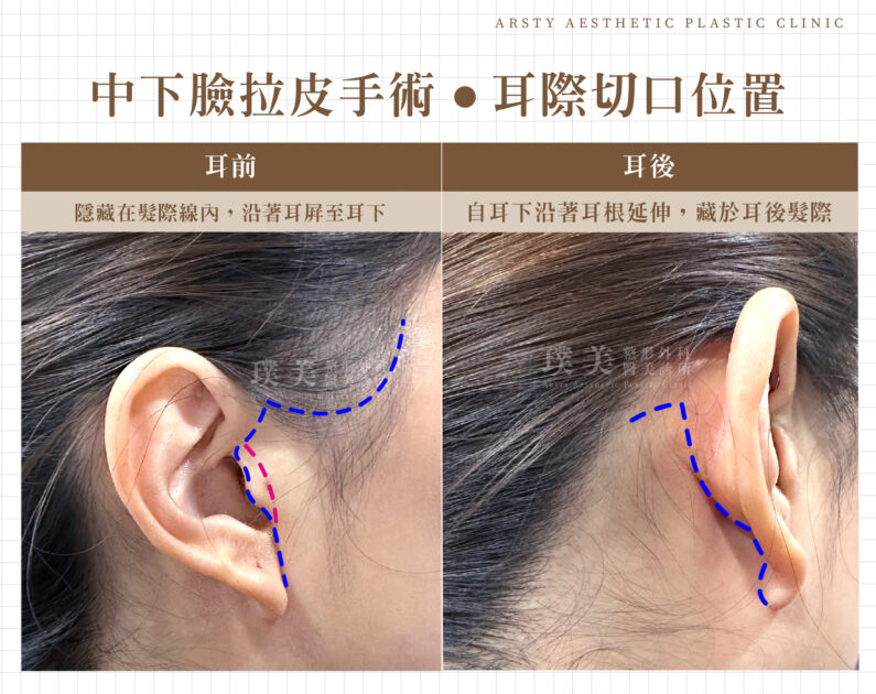 中下臉拉皮 切口位置示意圖 耳前及耳後