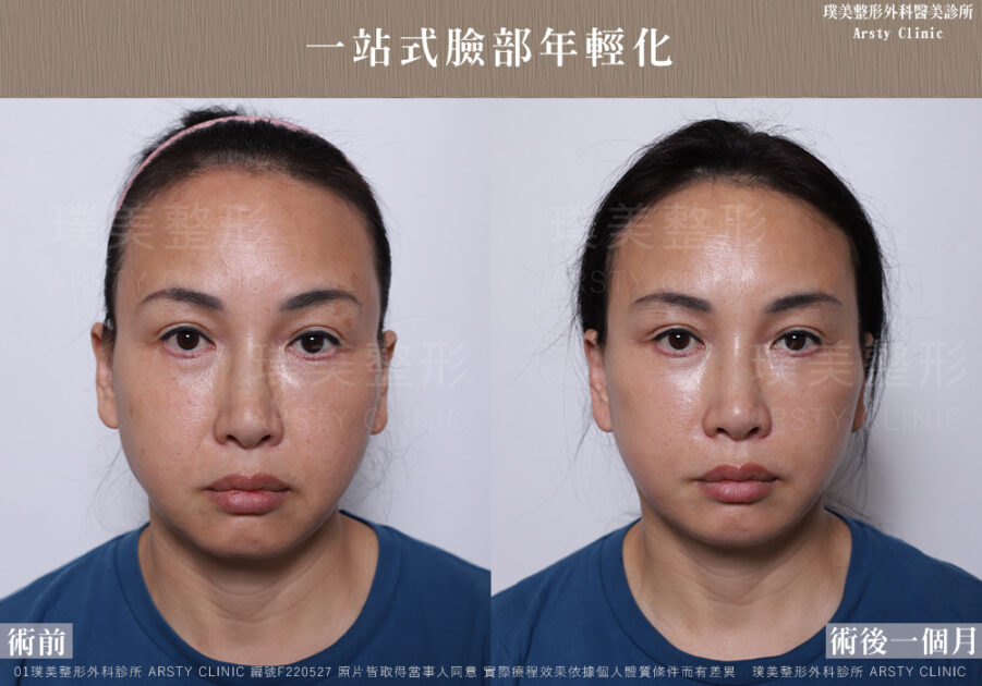 中下臉拉皮顳側拉皮臉部抽脂法令紋補脂 F220527 1M01 1