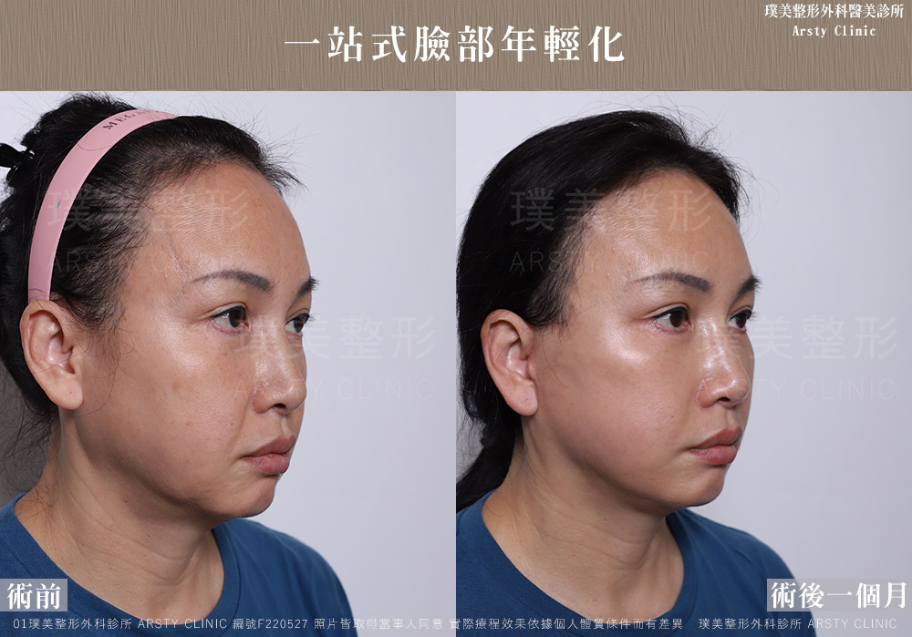 中下臉拉皮顳側拉皮臉部抽脂法令紋補脂 F220527 1M02 1