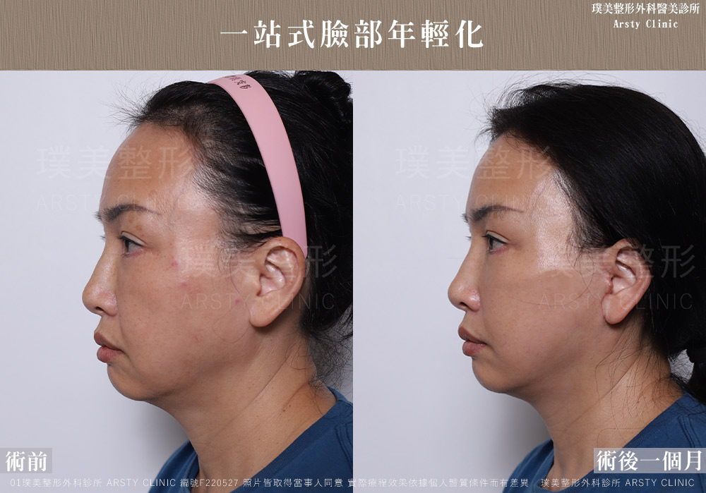 中下臉拉皮顳側拉皮臉部抽脂法令紋補脂 F220527 1M05