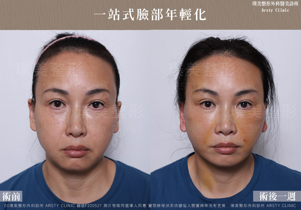中下臉拉皮顳側拉皮臉部抽脂法令紋補脂 F220527 1W01 1