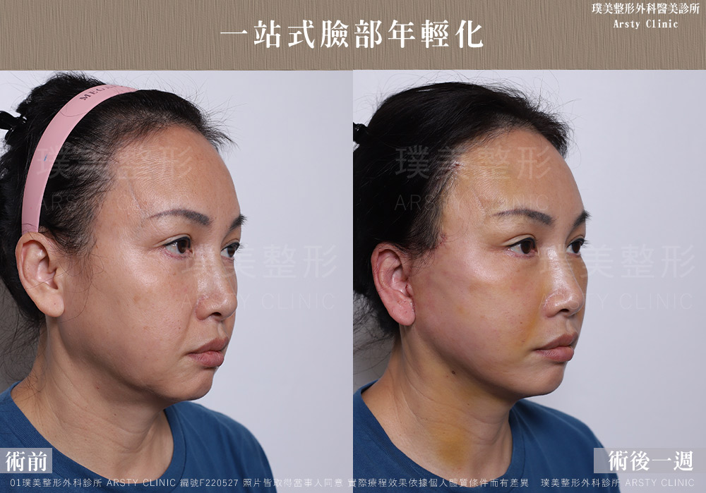 中下臉拉皮顳側拉皮臉部抽脂法令紋補脂 F220527 1W02 1