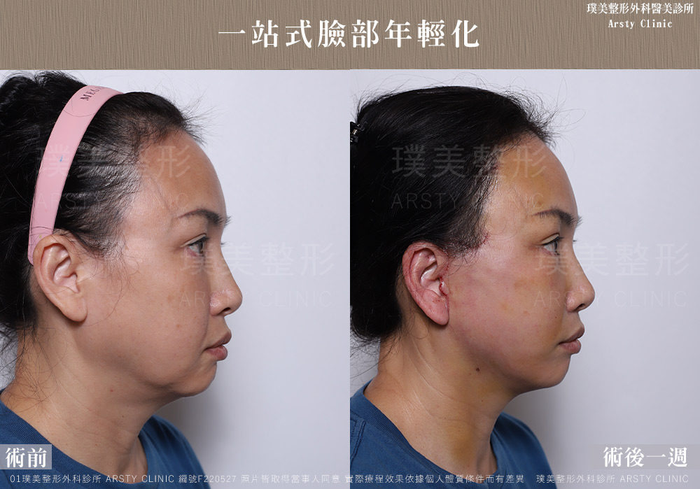 中下臉拉皮顳側拉皮臉部抽脂法令紋補脂 F220527 1W03 1