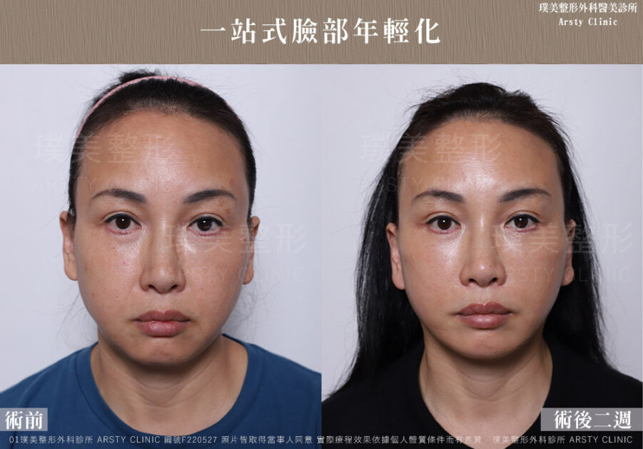 中下臉拉皮顳側拉皮臉部抽脂法令紋補脂 F220527 2W01