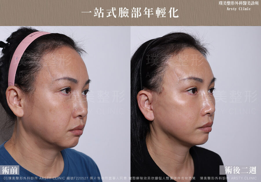 中下臉拉皮顳側拉皮臉部抽脂法令紋補脂 F220527 2W02