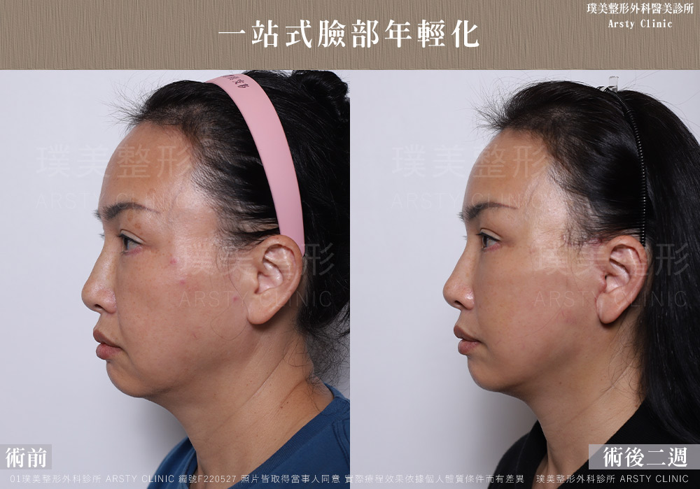 中下臉拉皮顳側拉皮臉部抽脂法令紋補脂 F220527 2W05 1