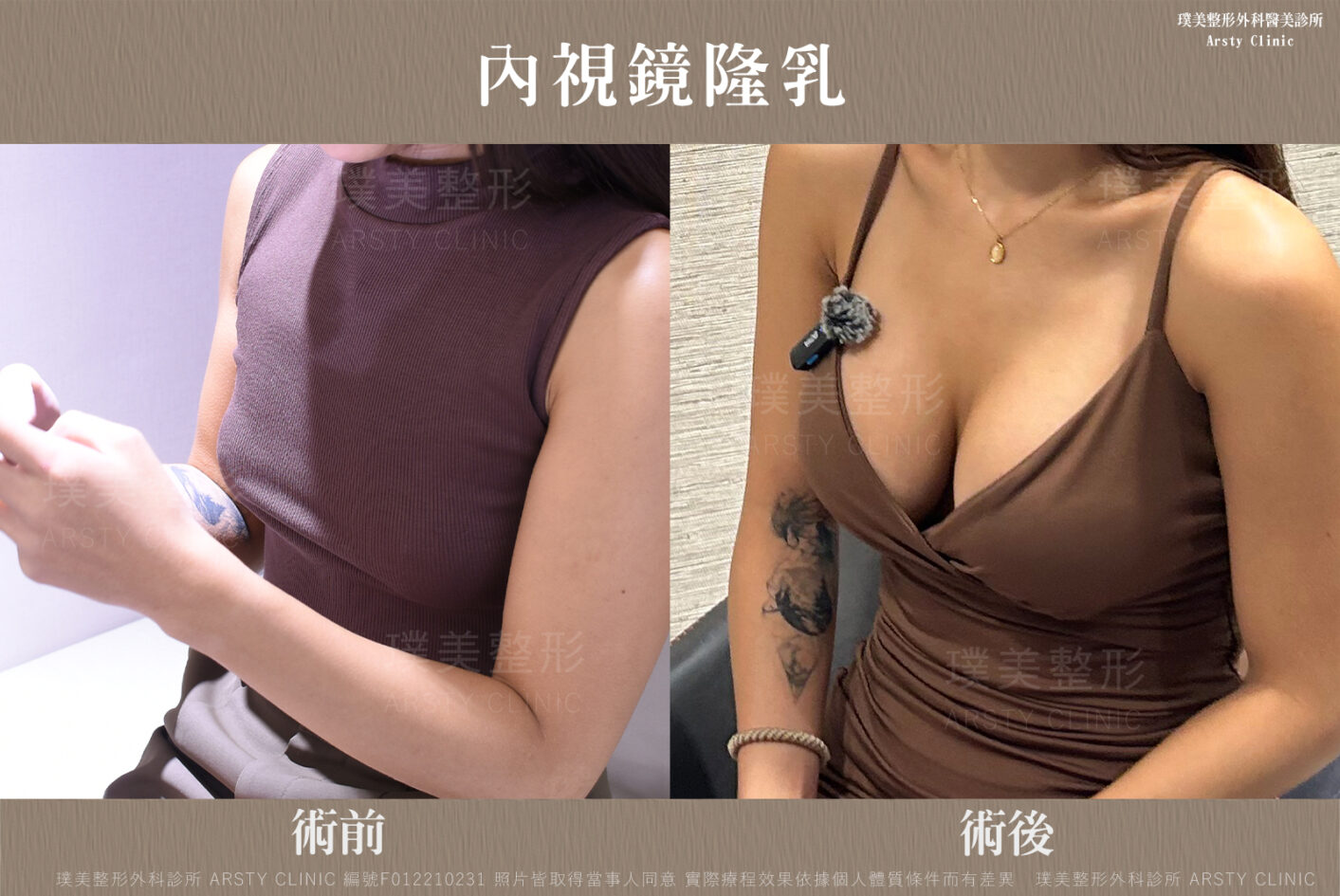 內視鏡隆乳 F012210231 生活照02