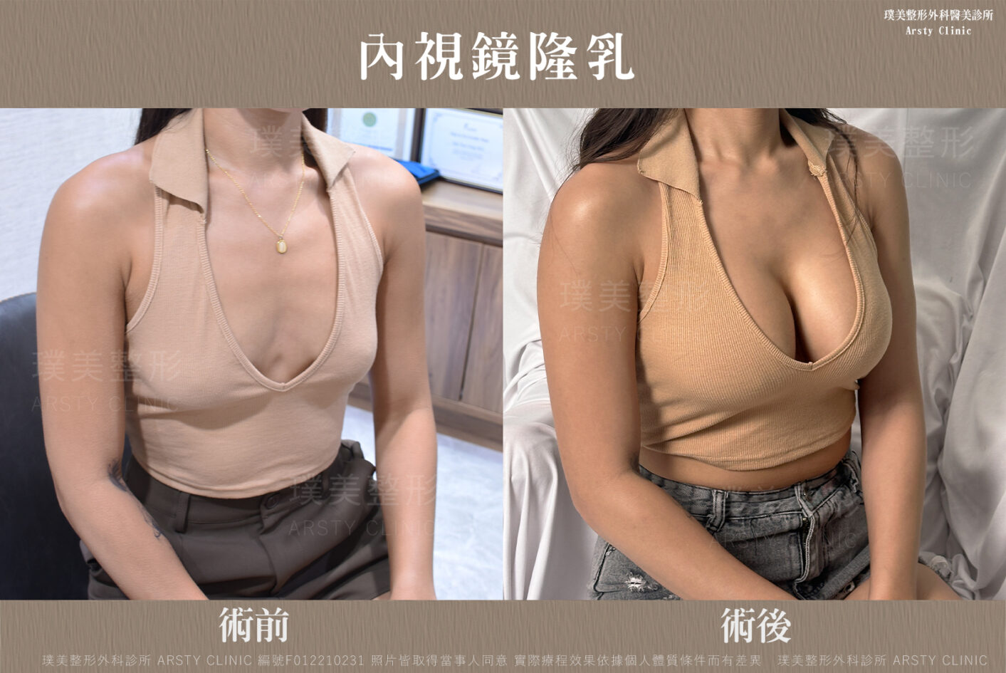 內視鏡隆乳 F012210231 生活照05