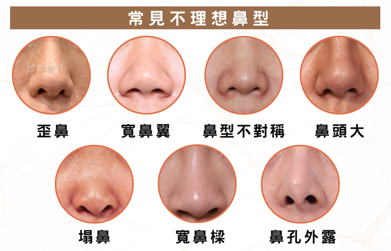 特殊鼻形 常見不理想鼻形