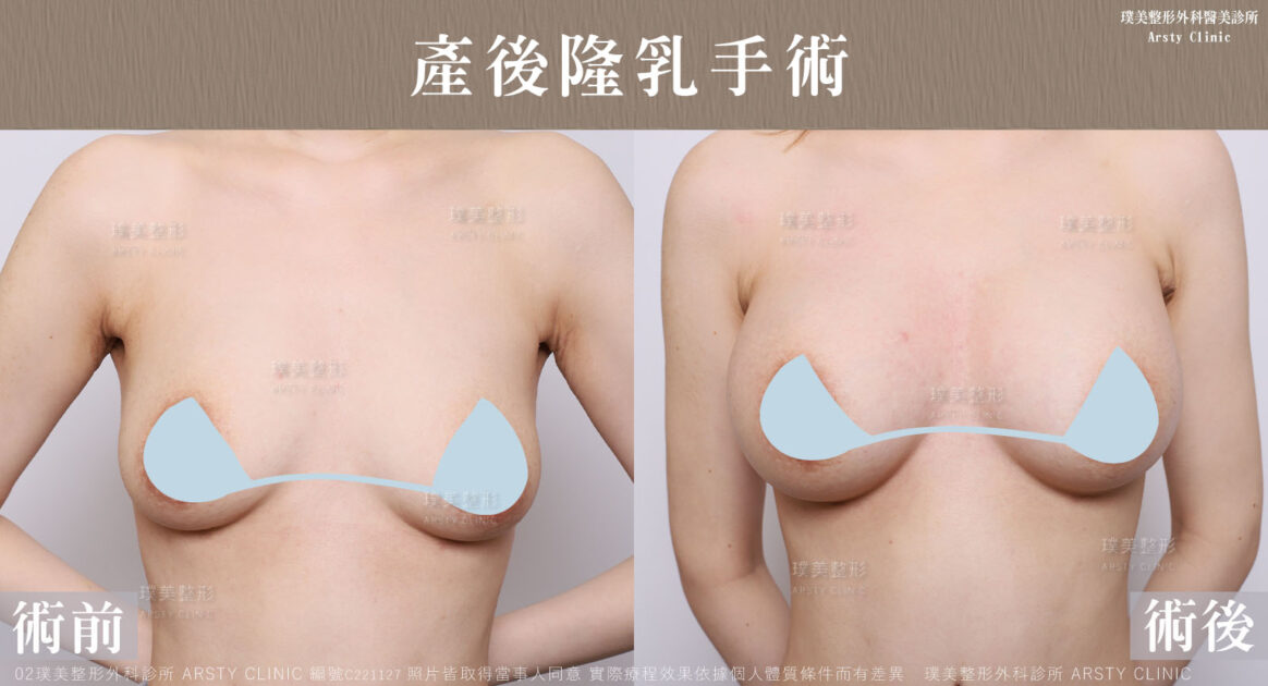 產後隆乳-C221127BA-局1 產後隆乳 C221127BA 局1
