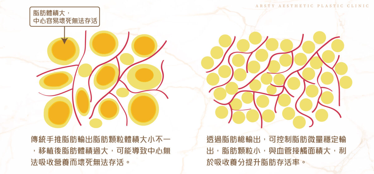 脂肪槍療程頁 01增加自體脂肪移植存活率