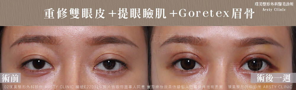 重修雙眼皮提眼瞼肌GORETEX眉骨 E220316 1W01
