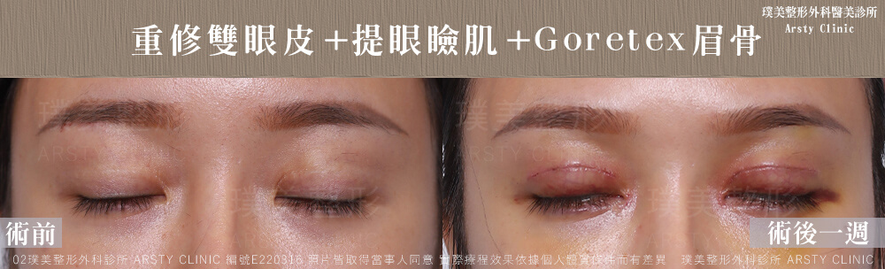 重修雙眼皮提眼瞼肌GORETEX眉骨 E220316 1W02