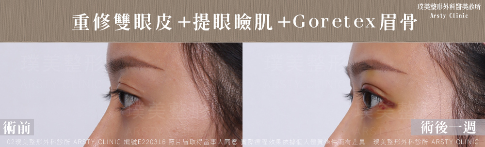重修雙眼皮提眼瞼肌GORETEX眉骨 E220316 1W04