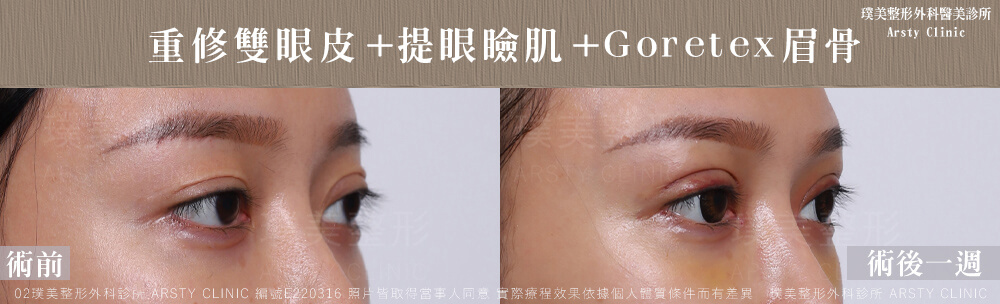 重修雙眼皮提眼瞼肌GORETEX眉骨 E220316 1W05
