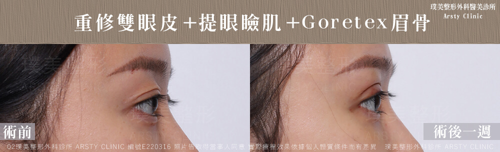 重修雙眼皮提眼瞼肌GORETEX眉骨 E220316 1W06