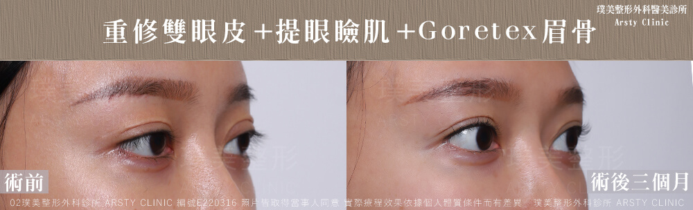 重修雙眼皮提眼瞼肌GORETEX眉骨 E220316 3M04