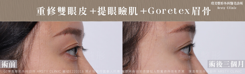 重修雙眼皮提眼瞼肌GORETEX眉骨 E220316 3M05