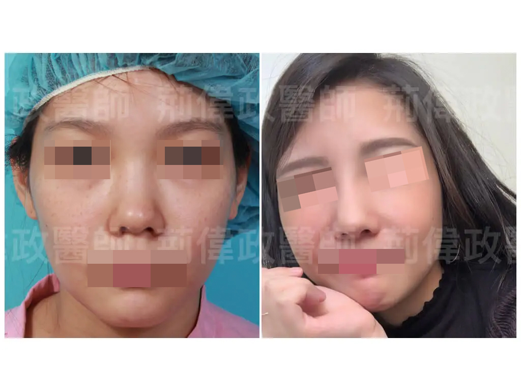 雙眼皮隆鼻rhinoplasty案例 A012210011 術前後對比03