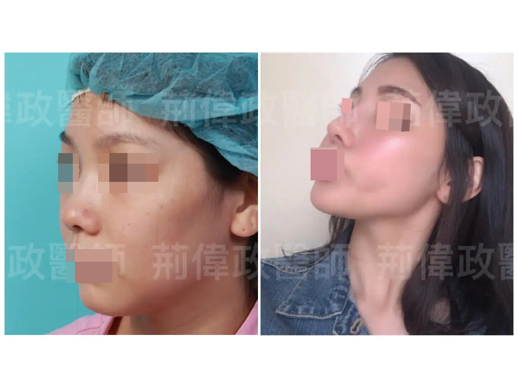 雙眼皮隆鼻rhinoplasty案例 A012210011 術前後對比05